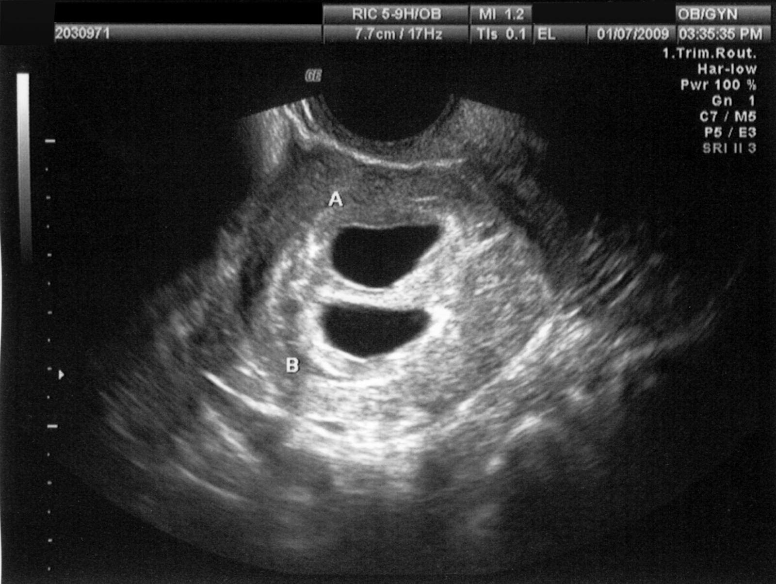 8 semanas de embarazo