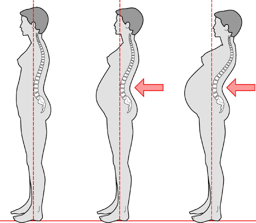 cómo aliviar el dolor de espalda durante el embarazo