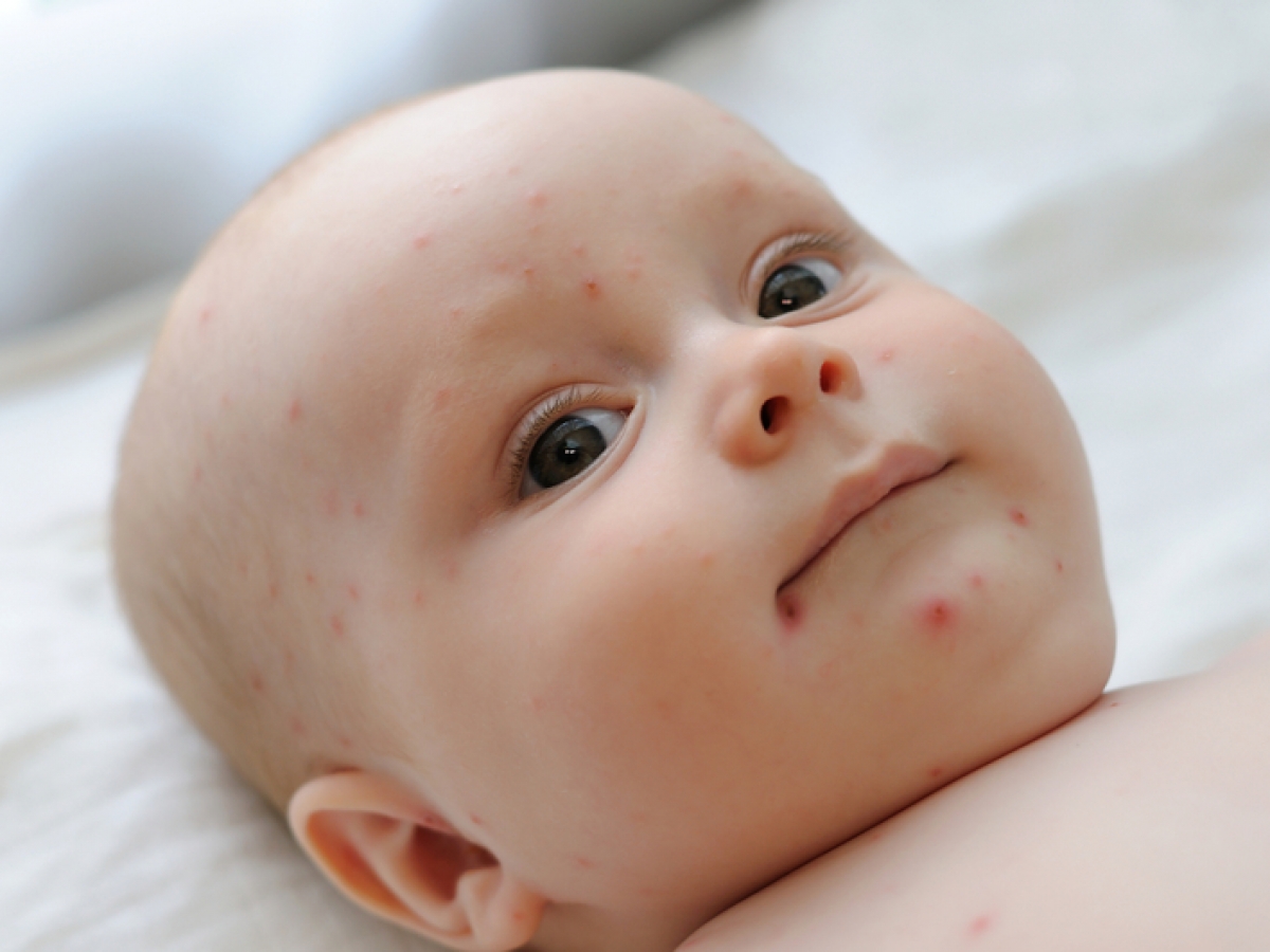 varicela en bebés