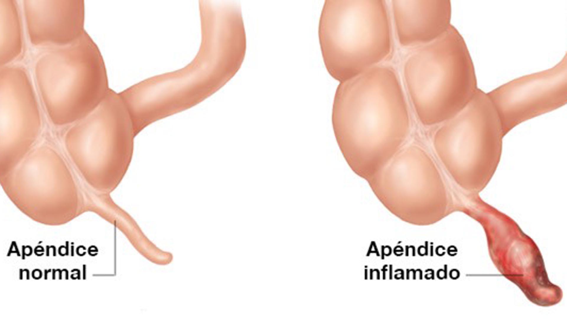 Apendicitis En El Embarazo Los Riesgos Que Enfrentar Hablemos De Familia